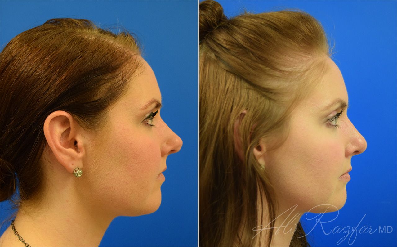 Rhinoplasty Before & After