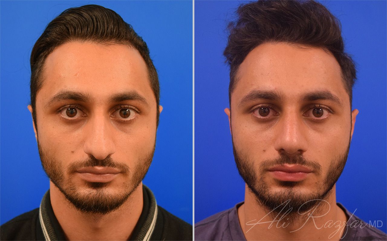 Rhinoplasty Before & After