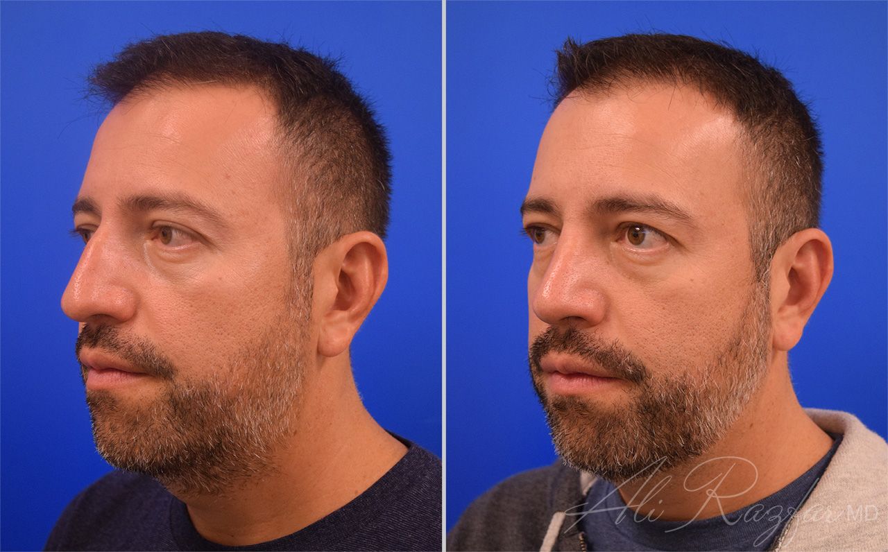 Rhinoplasty Before & After