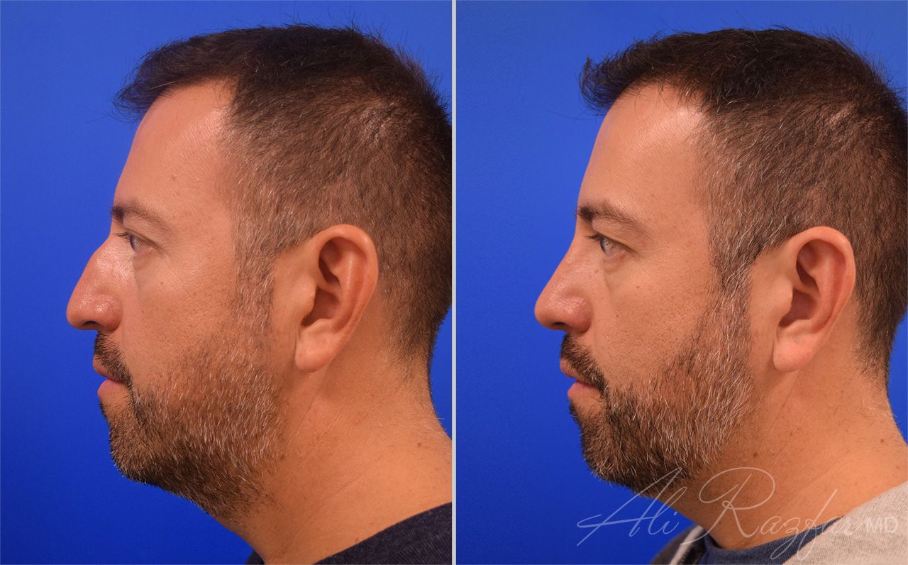 Rhinoplasty Before & After