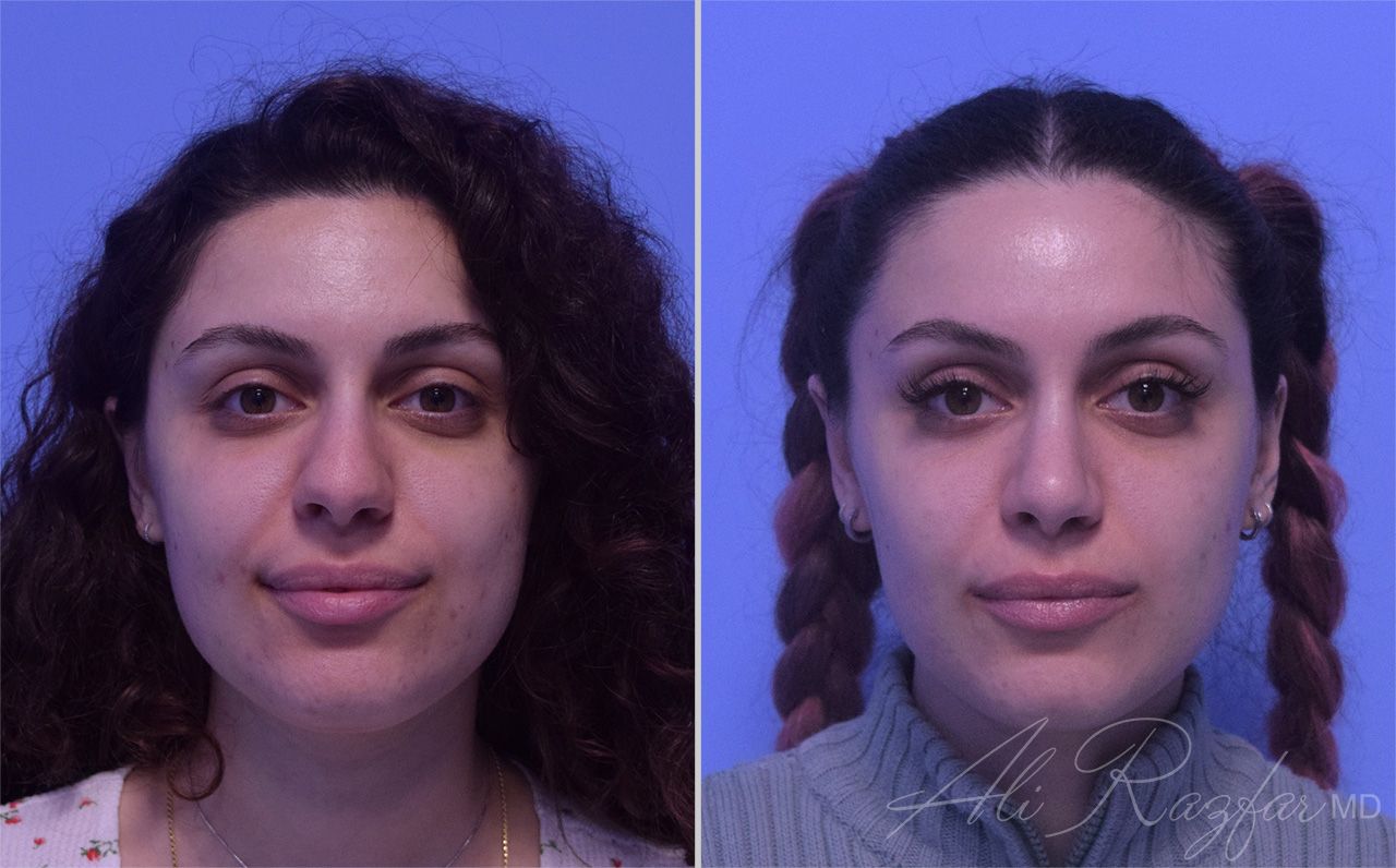 Rhinoplasty Before & After