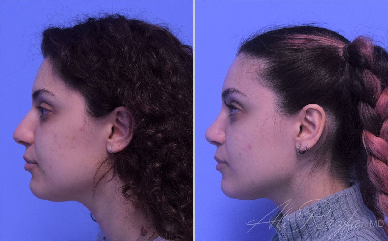 Rhinoplasty Before & After