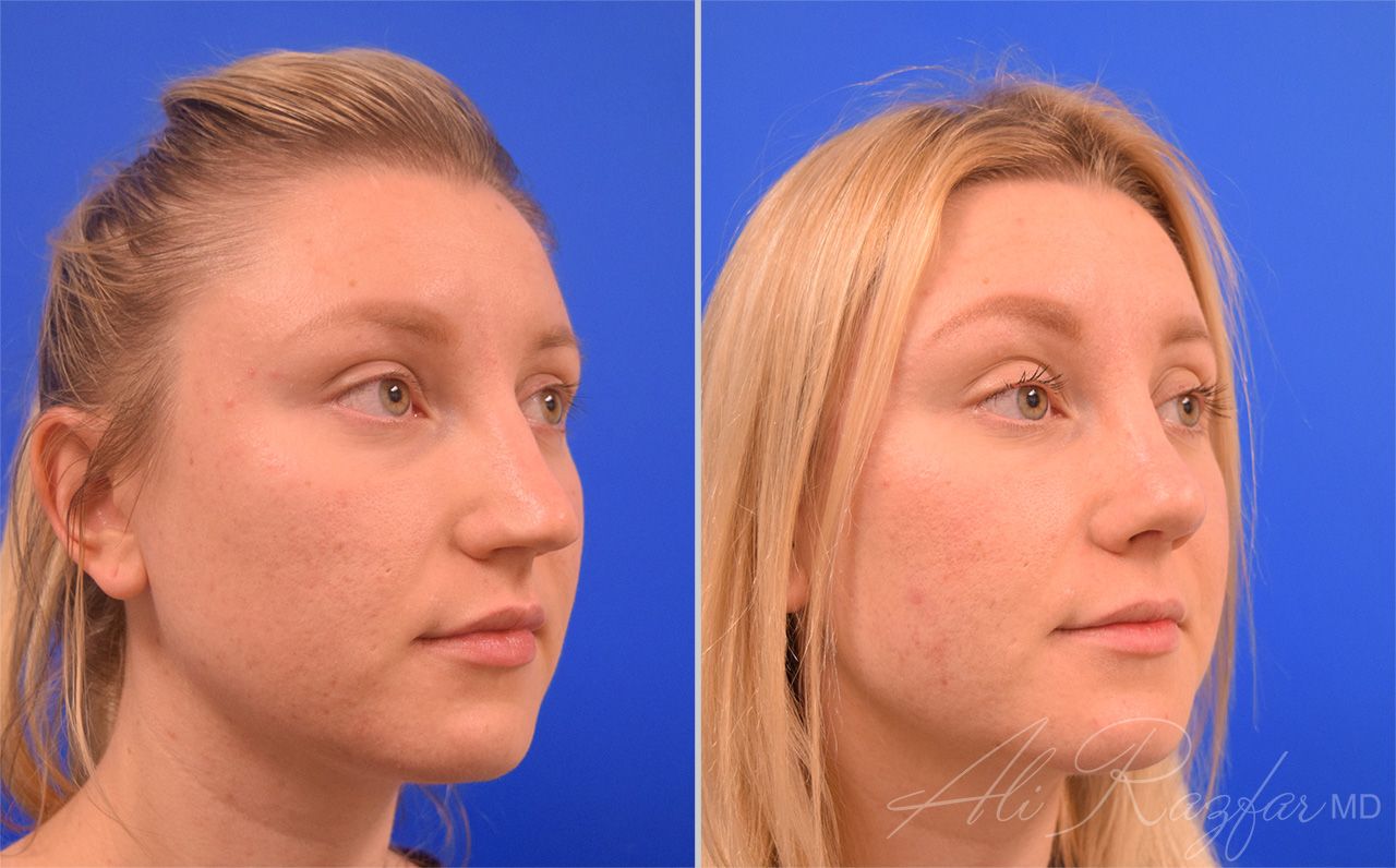 Rhinoplasty Before & After