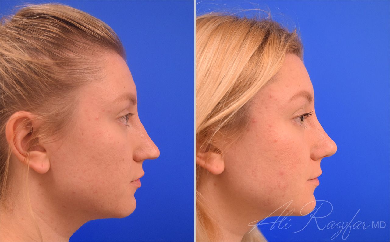 Rhinoplasty Before & After