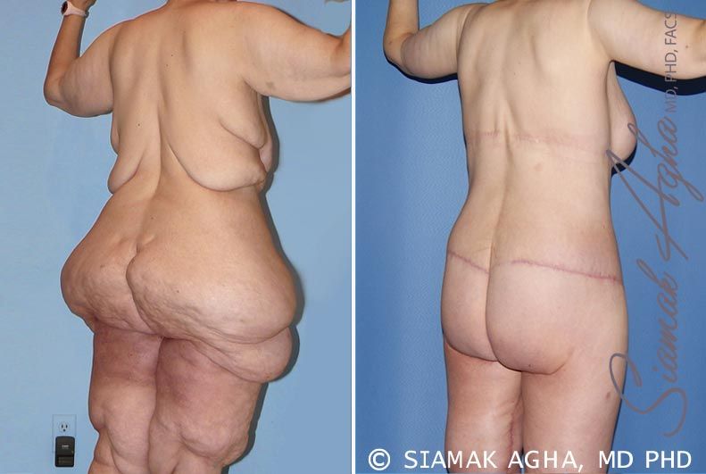 Total Body Lift Before & After