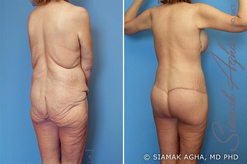 Total Body Lift Before & After