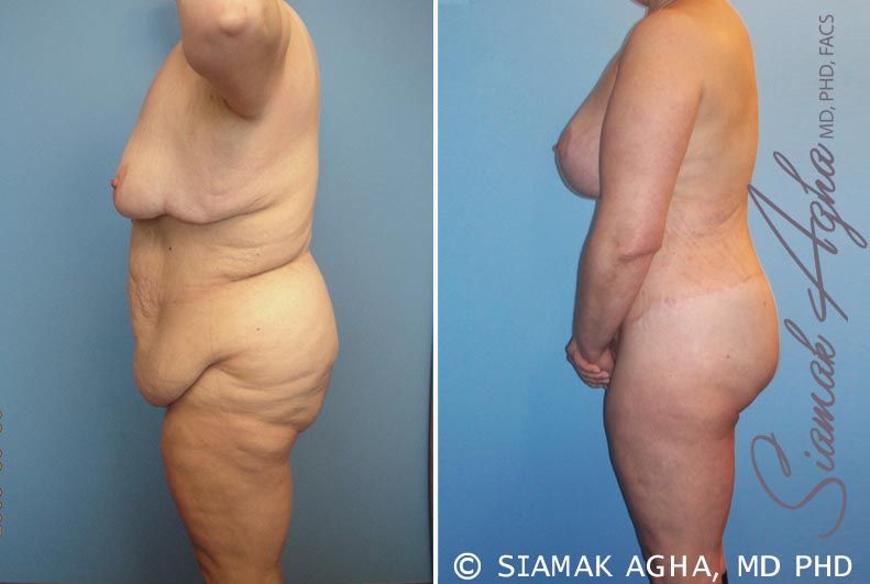 Total Body Lift Before & After