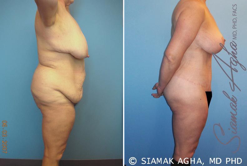 Total Body Lift Before & After