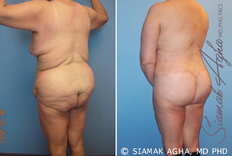 Total Body Lift Before & After