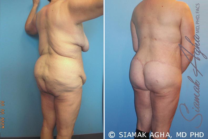 Total Body Lift Before & After