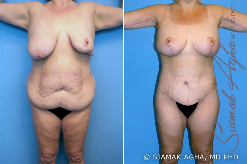 Total Body Lift Before & After