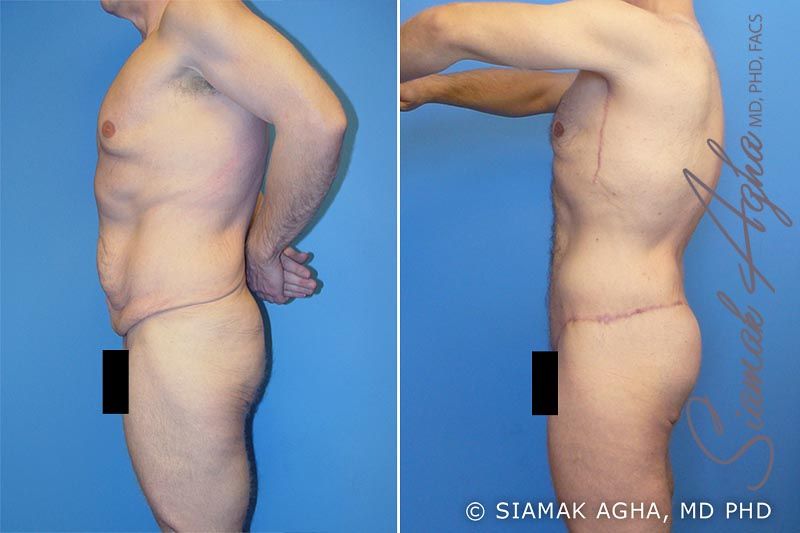 Total Body Lift Before & After