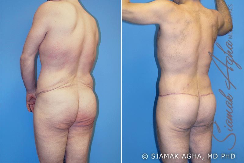 Total Body Lift Before & After