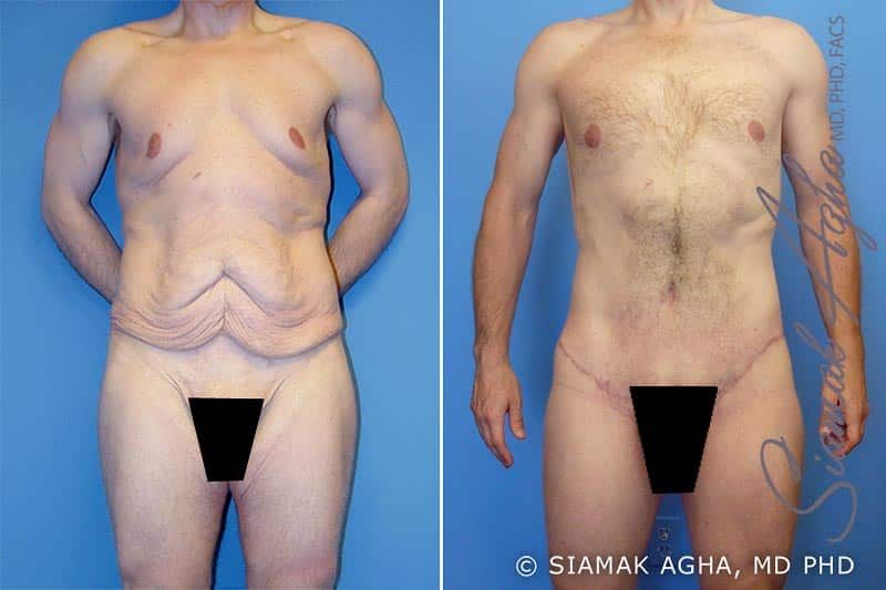 Total Body Lift Before & After