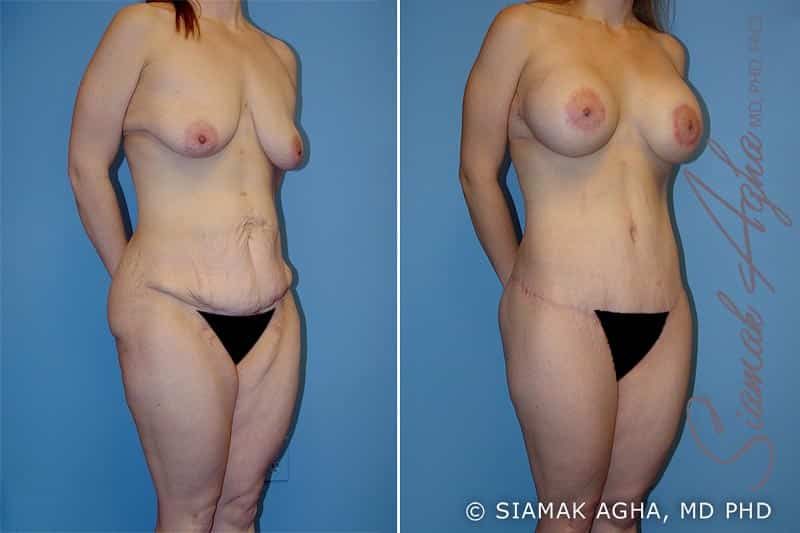 Total Body Lift Before & After