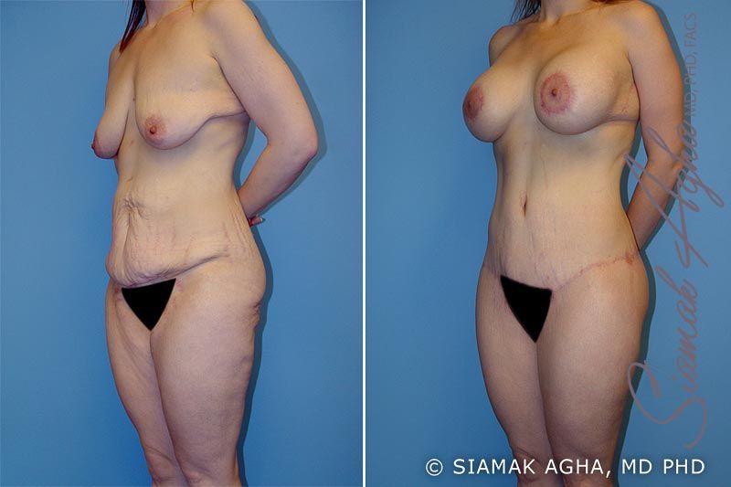 Total Body Lift Before & After