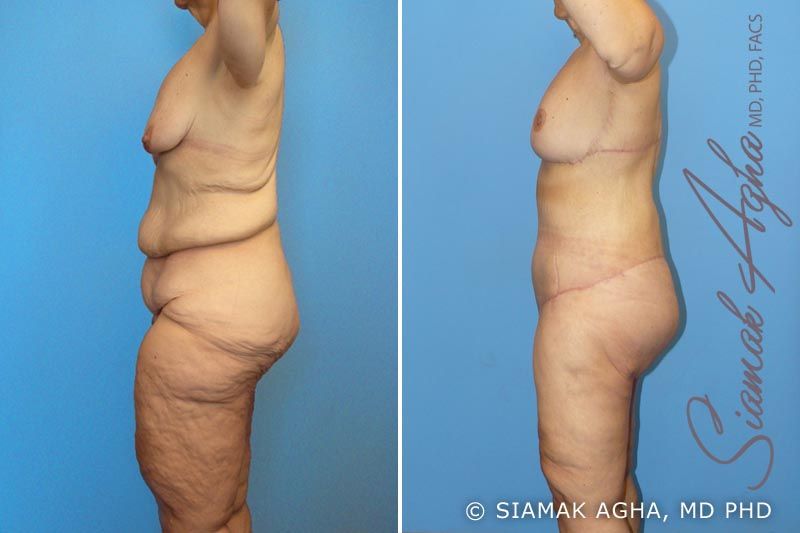 Total Body Lift Before & After