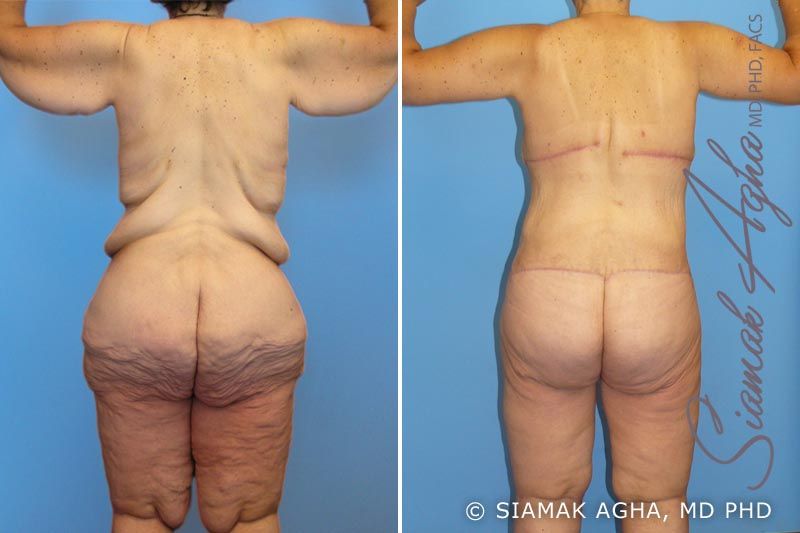 Total Body Lift Before & After