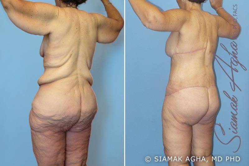 Total Body Lift Before & After