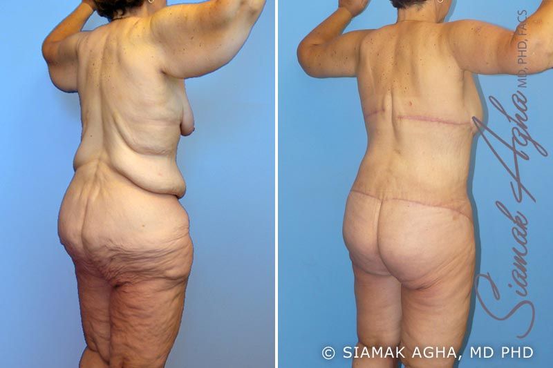 Total Body Lift Before & After