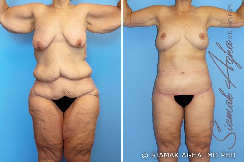 Total Body Lift Before & After