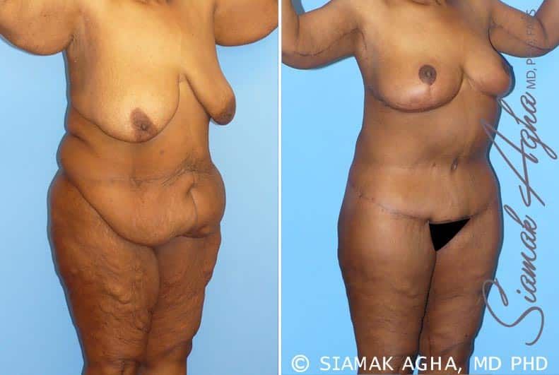 Total Body Lift Before & After