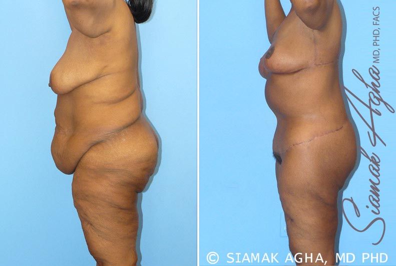 Total Body Lift Before & After