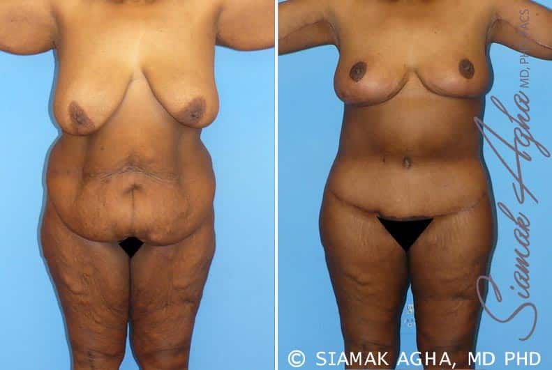 Total Body Lift Before & After