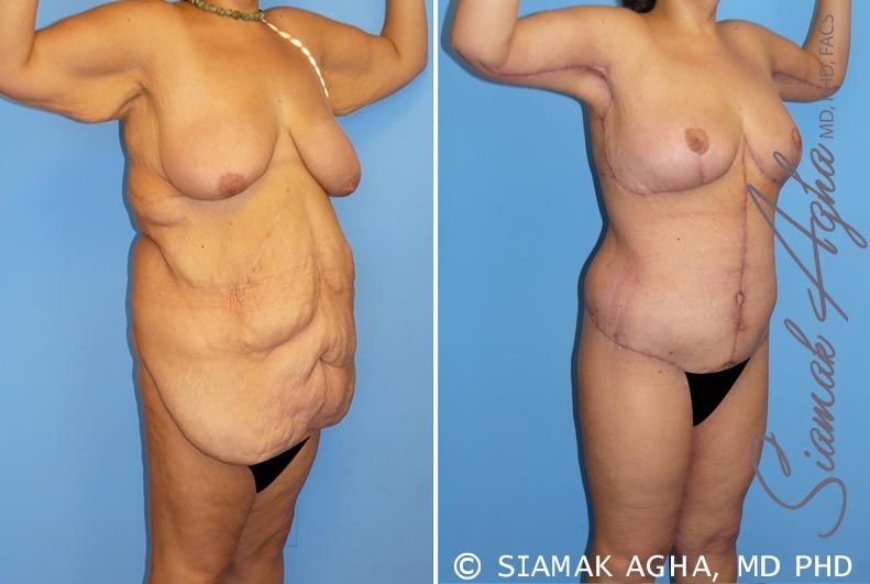 Total Body Lift Before & After