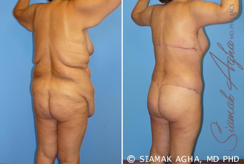 Total Body Lift Before & After