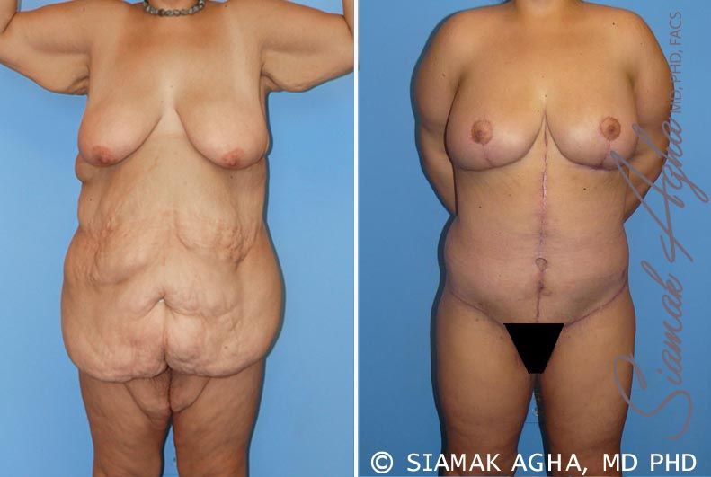 Total Body Lift Before & After