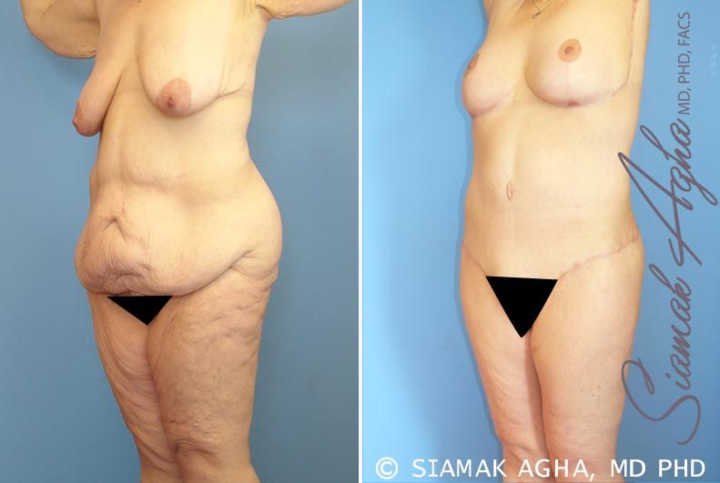 Total Body Lift Before & After