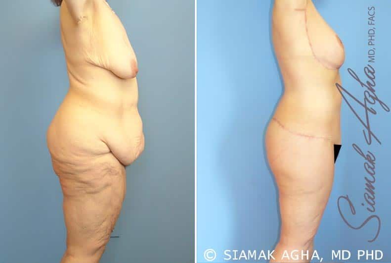 Total Body Lift Before & After