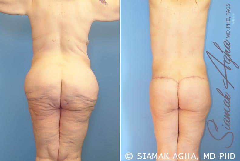 Total Body Lift Before & After