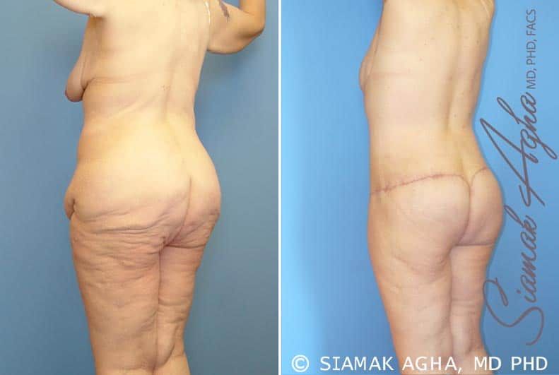 Total Body Lift Before & After