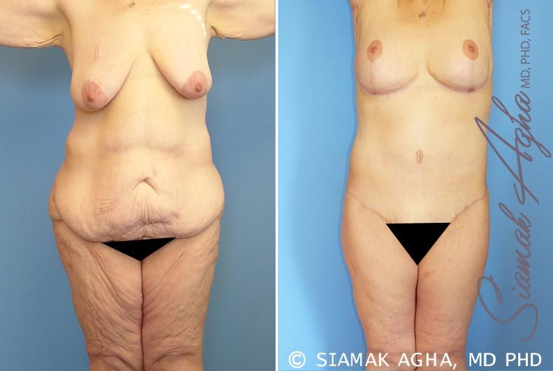 Total Body Lift Before & After