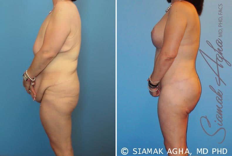 Total Body Lift Before & After