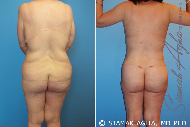 Total Body Lift Before & After