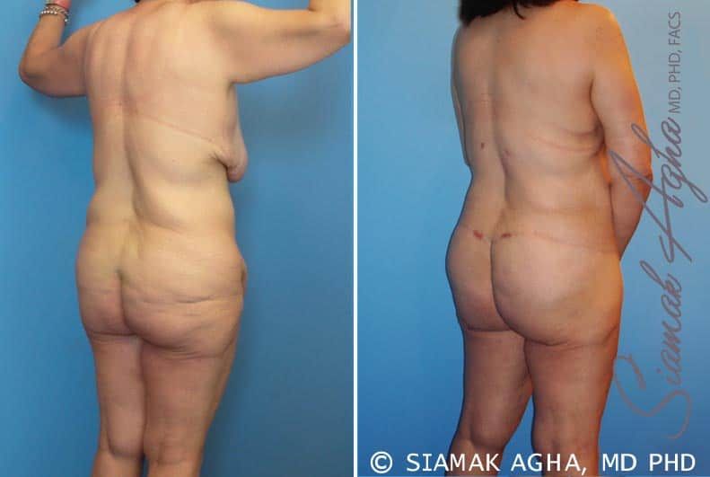Total Body Lift Before & After