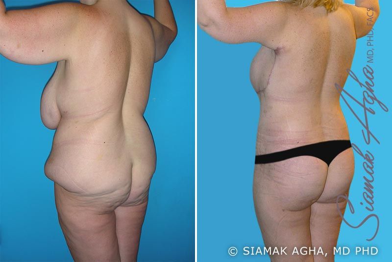 Total Body Lift Before & After