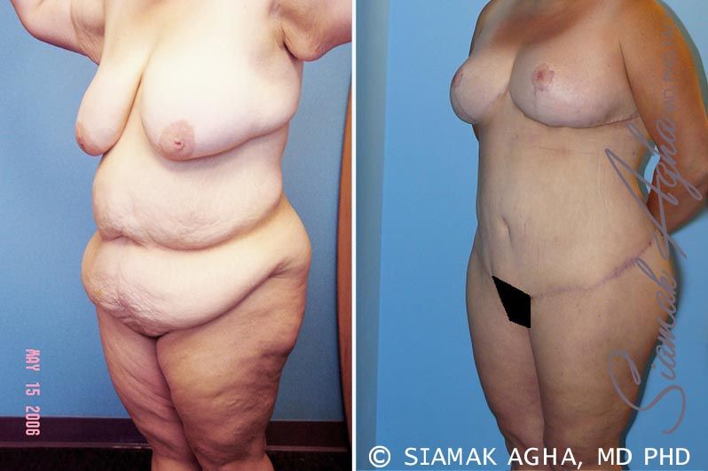 Total Body Lift Before & After