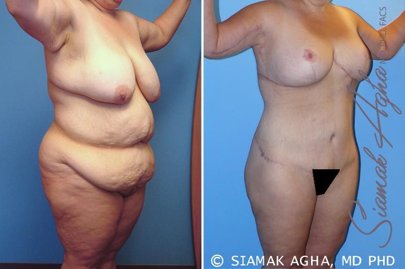 Total Body Lift Before & After