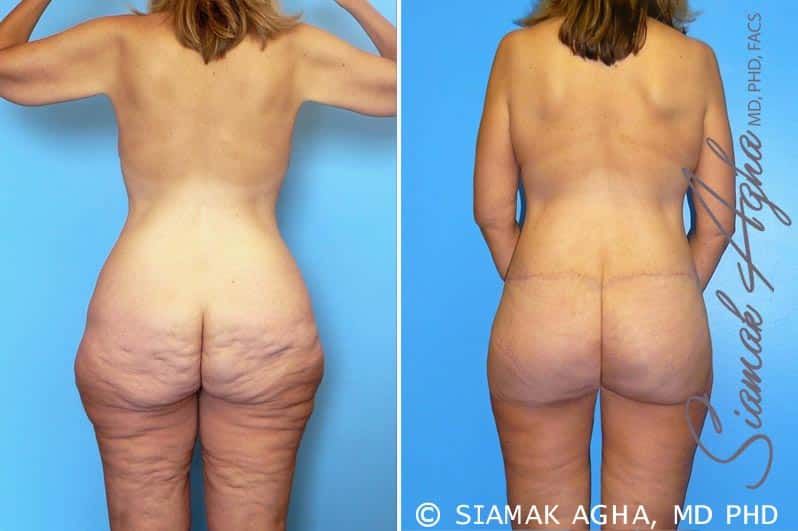 Total Body Lift Before & After