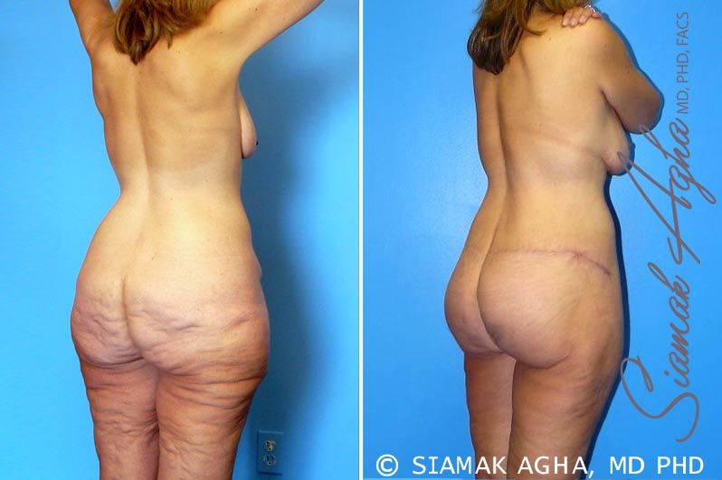 Total Body Lift Before & After