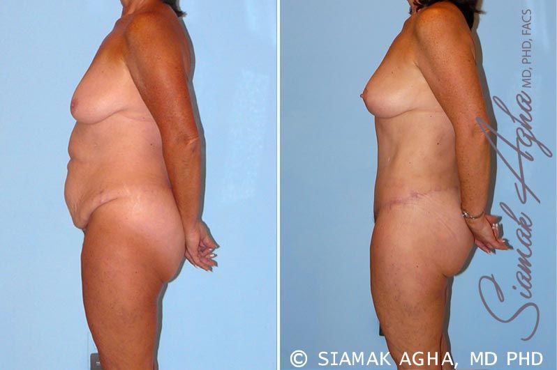 Total Body Lift Before & After