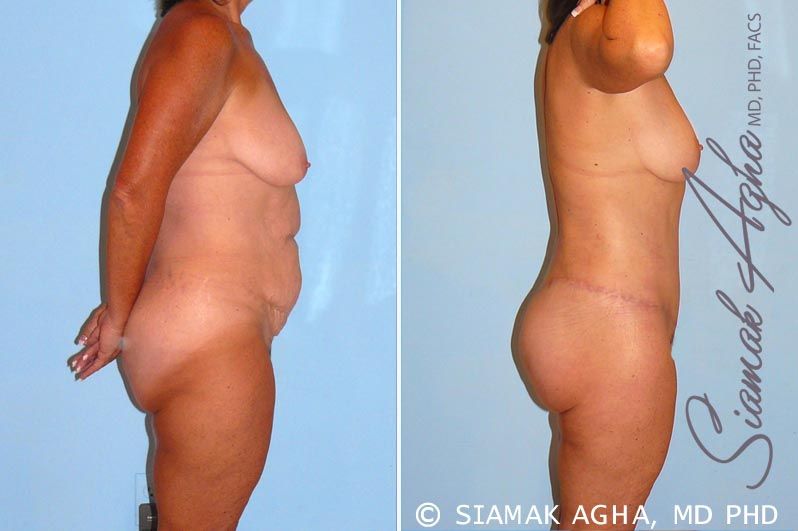 Total Body Lift Before & After