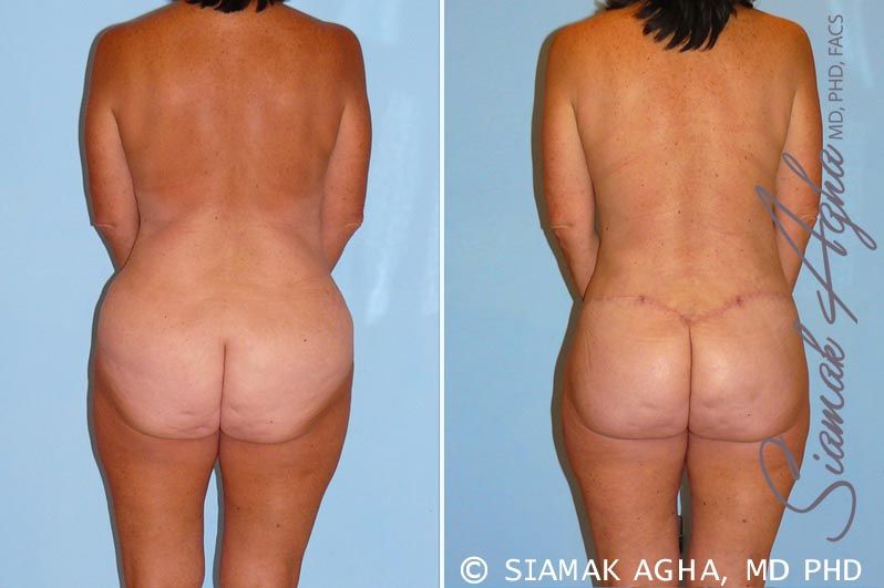 Total Body Lift Before & After