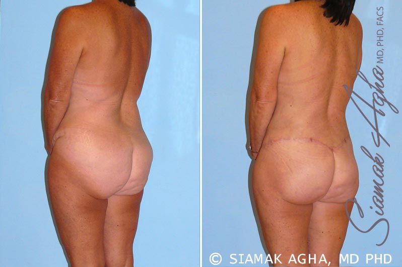 Total Body Lift Before & After