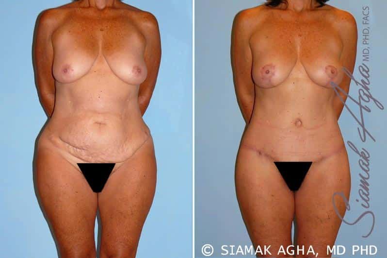 Total Body Lift Before & After