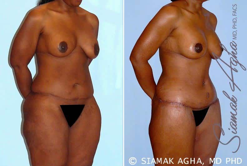Total Body Lift Before & After